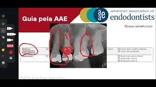 N&oacute;dulo pulpar e Reabsor&ccedil;&atilde;o - Parte II - c