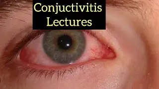 Conjuctivitis part 1, Eye lectures #eye #jatoi #eyelectures #conjuctivitis
