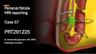 | Case 57 | Perianal transsphincteric fistula  Grade 4 with side-branch | PRT291225