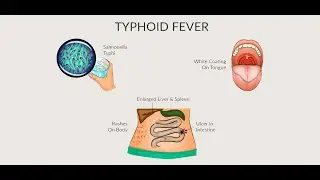 Presentations of Typhoid Fever ; Complicated cases, Types of Surgeries, Indications for Surgery