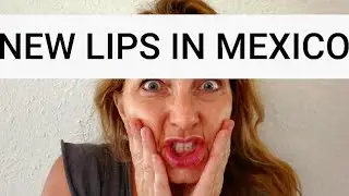 My wife got Bargain Lip Filler in Tijuana, Mexico
