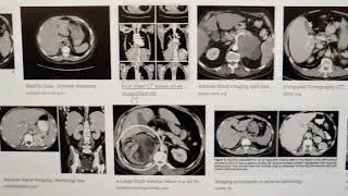 Anatomies to include in CT Chest scan / protocol