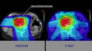 Pancreatic Cancer Treatment with Proton Therapy