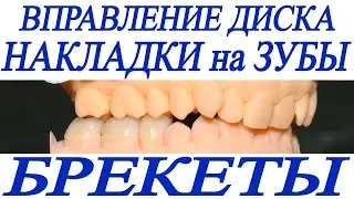 Щелкает сустав, скученность зубов, ортотик, накладки на зубы, брекеты, ортодонтическое лечение.