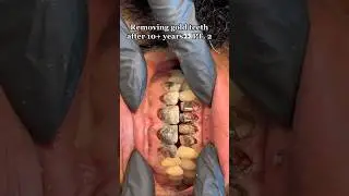 He Almost Lost All Of His Teeth?!