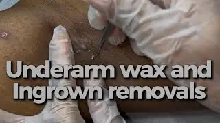 Underarm wax, ingrown hair removal and blackhead removals 