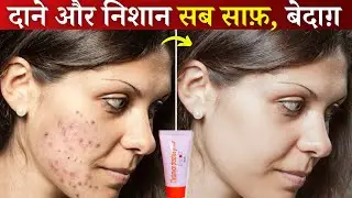 Erytop Gel | दाने और निशान हफ़्ते भर में साफ़ कर दे बिना side effect के | Clean Pimple & Acne