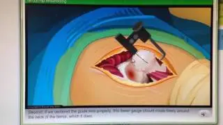 THE DOCTOR IS IN | Virtual Hip Resurfacing Surgery. EdHeads
