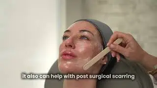 CO2 Laser Treatment EXPLAINED 🔥 What REALLY Happens at Vbeauty Medical Spa