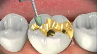 Inlay   Gold