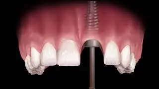 Multi-Purpose Abutment to Fabricate a Custom Abutment