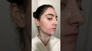 Посмотрите, как я успокаиваю свой гормональный всплеск за неделю 🥰✨ #уходзакожейсакне #гормональн...