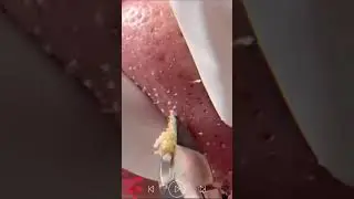 blackhead removal from nose/ old aged blackheads removal