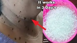 diy skin tag removal in 3 day  / skin tag removal natural remedies with lemon remedy 💞