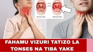 TATIZO LA TONSES,CHANZO NA TIBA
