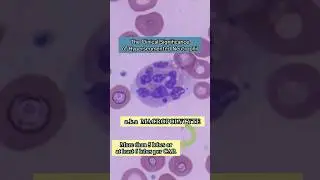What is a Macropolycyte or Hypersegmented Neutrophil? #shorts #medtech #medtechstudent #foryou #fyp