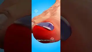What Happens When Your Nail Falls Off😮 #short #viralvideo - Creativelearning3d