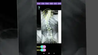 Measure Cobb angle in spine x-rays with App in android in Playstore