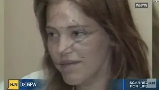 Model in face slashing recalls attack