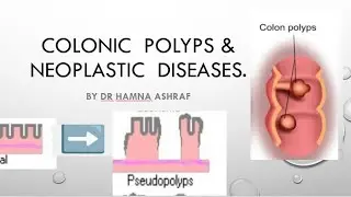 Non Neoplastic Polyps. #drhamnaashrafmbbs #4thyearmbbs #specialpathology #clinical #lectures