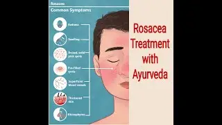 Rosacea Successful Treatment / Burning Skin / Redness of skin / Itchy Skin / Dryness of skin /