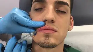 Restylane Defyne lip filler treatment in a male patient by Dr. Shaun Patel