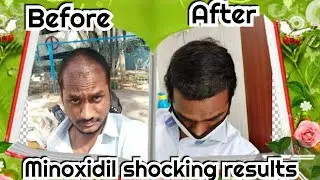 Minoxidil review after applying for 4 months. Minoxidil Morr f 10%.