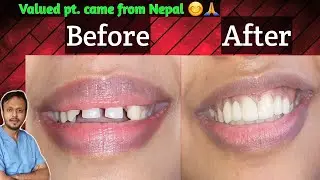 दाँतो के बीच मे gap का Permanent इलाज सिर्फ 5 दिनों में ! Treatment of Midline diestema