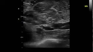 Anterior interosseous enlargement at pronator exit. Nerve ultrasound.