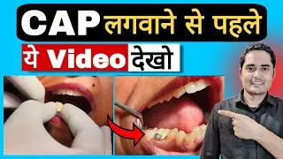 Dant Me Cap Kaise Lagate Hain? Tooth Capping After Root Canal !