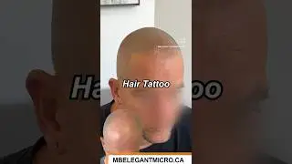 #balding #hairloss #hairlosssolution  #hairline #hairtransplant #thinninghair  #smp #thinhair