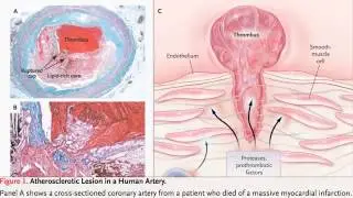 How to take precuation against Heart Desease