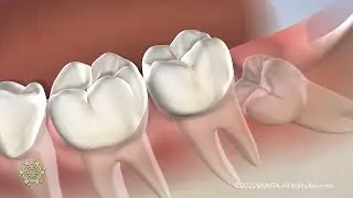 Wisdom Teeth with Dr. Rehrer at Beacon Oral & Maxillofacial Surgeons