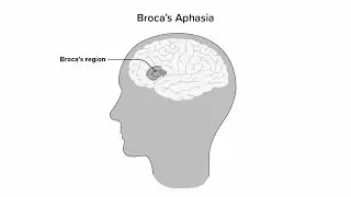 LNG4323_03 PSYCHOLINGUISTICS SEC03 GOOGLE SITES (BROCA&rsquo;S AND WERNICKE&rsquo;S APHASIA)