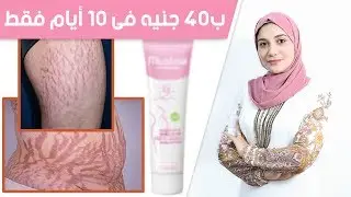 ب 40 جنيه بس هتختفى 👌 علامات تمدد الجلد | سترتش مارك | الخطوط البيضاء فى 10 أيام