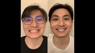 Crest 3D White-strips Sensitive White Review (BEFORE/AFTER)