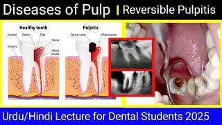 Reversible Pulpitis_Diseases of Pulp_Part#01 Urdu/Hindi lecture for Dental Students_new session 2025