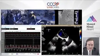 TF-TMVR using 29mm SAPIEN-3 Valve