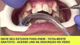 Como Colocar Aparelho Dental: Colocando aparelho