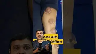 Shocking Truth about Cupping (HIJAMA) Therapy for Varicose Veins #veindoctor