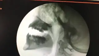 Lateral video fluoroscopy in a cath lab for a patient with VPI for Speech Surgery