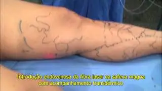 Cirurgia / Tratamento de Varizes &agrave; Laser Dr. Eduardo Sisterolli