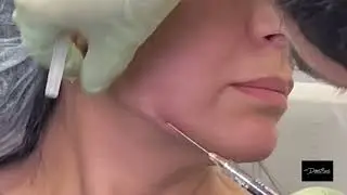 Raffermissement de l’Ovale du Visage à l'Acide Hyaluronique | Expertise en Médecine Esthétique Paris
