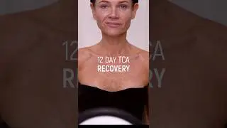 20% TCA Peel Recovery | 12 Days of Healing My Neck & Chest 🧴✨