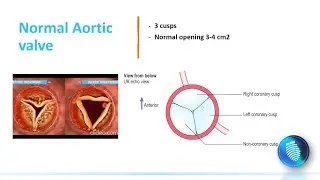 Aortic valve anatomy in Echocardiography