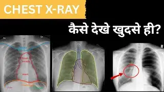 Chest xray kaise dekhe|| how to read chest xray