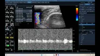 IQ 719 ACA RI PI TCD ULTRASOUND