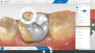How to design a ceramic onlay on CEREC SW 5.2.8