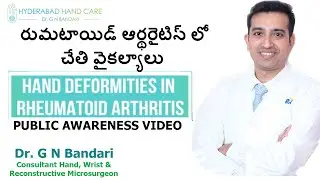 కీళ్ల వాతం లో చేతుల వంకర్లు మరియు వైకల్యాలు | Dr.Gopinath Bandari | Hand and Micro-Surgeon
