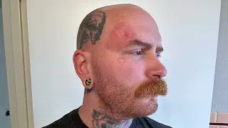 BCC Skin Cancer Aldara Treatment Update: CANCER FREE!